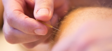 Dry Needling
