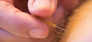 Dry Needling